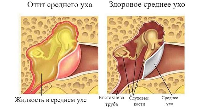 Шунтирование барабанных перепонок